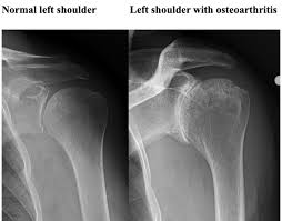 Image result for Shoulder XRay