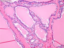 It also often results in an enlarged thyroid. Webpathology Com A Collection Of Surgical Pathology Images