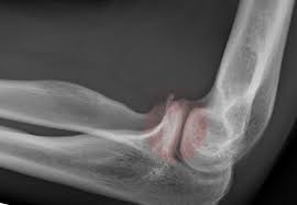 Image result for Coronoid Process Fracture