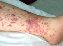 Una piastrinopenia è generalmente considerata grave quando la conta piastrinica è inferiore a 50.000 unità per mm³ di sangue. Trombocitopenia O Piatrinopenia Patogenesi