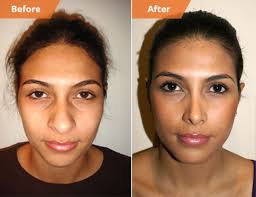 How much does a nose job cost in texas. Best Revision Rhinoplasty Surgeon In The World