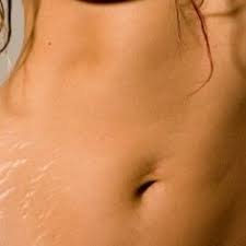 Take Some Coffee Grinds With Olive Oil And Make Into A Paste Massage Well Into The Area With Stretch Marks Stretch Marks Health And Beauty Tips Beauty Health