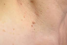 Condoms can only slightly reduce the risk of infection, because hpv is so easily transmitted. Hpv Warzen Hals Terminvereinbarung