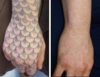 Compare get a consultation or call: Laser Tattoo Removal Seattle Laser Tattoo Removal