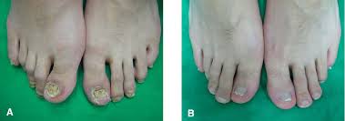 Metaanalysis for the evaluation of risk factors for carpal tunnel syndrome (cts) part ii. Figure 4 From A Case Of Reiter S Syndrome That Was Treated With Etanercept Semantic Scholar
