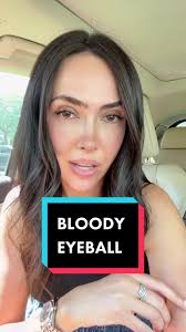 @sum bloody eyeball explained #subconjunctivalhemorrhage #bloodyeye #eyedoc  #fyp #learnontiktok #eyehealth #stich #eyes