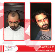 Gercek Dogal Sonuclar Ancak Gercek Tecrube Ve Uzmanlik Ile Mumkundur 90 530 182 4373 Anatoliasacekim Com Anatoliahair Anatoliasace Sac Dogal Gercekler