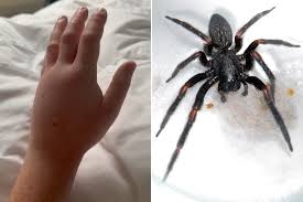 Image result for Tarantula Bite