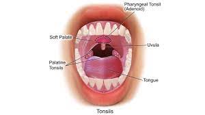 Tonsil Removal Tonsillectomy