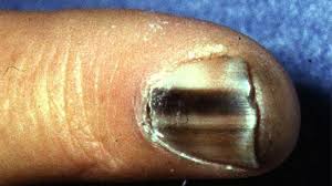 May be present with iron deficiency. Subungual Melanoma Symptoms Causes And Treatments