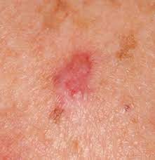 Rash is a general term, and the specific qualities of the rash often give doctors clues to the cause. Dermofit