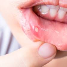 Image result for gums cancer symptoms