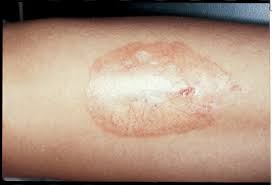 Image result for Pigment stains on the shin
