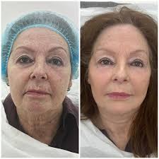 Signature Liquid Lift. It's all the little things✨✨✨✨✨ THAT MAKE THE  BIGGEST DIFFERENCE… 💥 Small changes. BIG RESULTS. Liquid Face Lift Points.  Brow bone. Temple hollows. UnderEyes. Cheekbones. Cheek fat pads. Alar