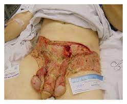 The disease is most often found in men between the ages of 50 and 60. Fournier S Gangrene In A Heterosexual Man A Complication Of Neisseria Meningitidis Urethritis