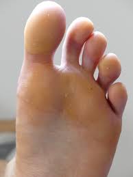 It lies directly in front of the iris and pupil, and allows light to enter the eye. Hornhaut Entfernen Fusspflegeblog