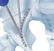 Low Profile Pelvic System (3.5 mm) | Products | DePuy Synthes
