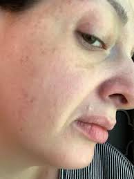 Help Please Oh acne why it so itchy . What are the prevention tips for  acne🥴😵‍💫 Is this part of aging ? I am 42 yrs old and I never experience  this