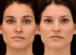 Are Nanofat Procedures the Future of Plastic Surgery?