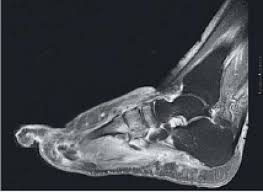 It causes joint and bone damage that may lead to foot deformities which are severe. Charcot Fuss Auf Die Fruhe Diagnose Kommt Es An