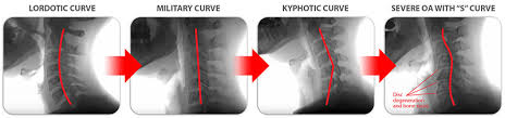 Learn more about the causes. Cervical Vertigo And Cervicogenic Dizziness Caring Medical Florida