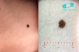 Pin On Cancerous Moles