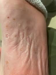 Image result for pompholyx soles of feet