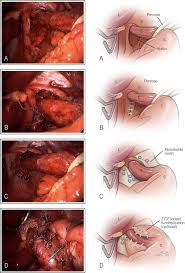 Image result for Hernia Reduction