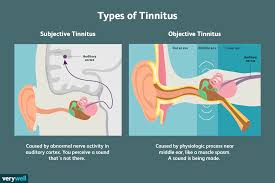 Image result for Eustachian Tube Dysfunction
