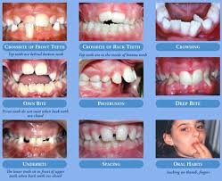 Braces before 12 year old molars erupt. Why Visit An Orthodontist By Age 7 L M Orthodontics Orthodontists In Doylestown Glenside Perkasie Pa Warrington Bucks County Montgomery County