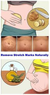 Remove Stretch Marks Naturally Stretchmarksremedies Stretch Marks Stretch Mark Removal Strech Marks