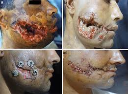 Two shots were made with a remington 870 shotgun which is typical for a home defense shotgun nowadays. Facial Gunshot Wound Debridement Debridement Of Facial Soft Tissue Gunshot Wounds Sciencedirect