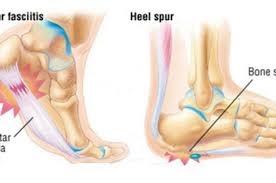 Cara berkesan mengatasi sakit tumit kaki yang ramai orang tak tahu sub. Mudah Dan Cepat Cara Alami Redakan Nyeri Pada Tumit Telapak Kaki Semua Halaman Nakita