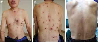 Image result for syphilis ulcer