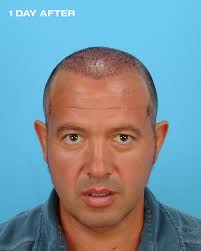 12 months. Thousands of grafts. One life-changing transformation. 🔥 At  Bauman Medical, results are more than visible—they're life-altering. From  Day 1 post-procedure to 12 months later and beyond, our patients experience  renewed