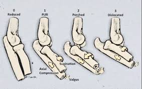 Lie on your back with your injured knee bent and your foot flat on the floor. Posterolateral Rotatory Instability Of The Elbow Part I Mechanism Of Injury And The Posterolateral Rotatory Drawer Test Abstract Europe Pmc