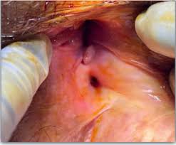 Image result for Perirectal Abscess