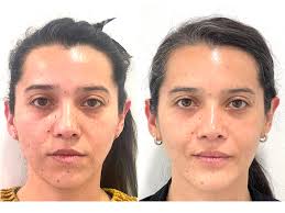 🎥 Arthroscopic Discopexy in Wilkes V: Before, During, and After In this  reel, we present the case of a patient diagnosed with Wilkes Stage V,  showing advanced disc displacement and joint degeneration.