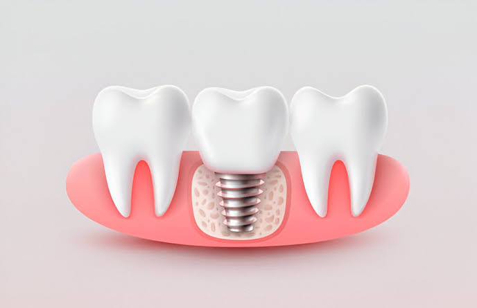 Can You Get a Front Tooth Implant the Same Day as Extraction?