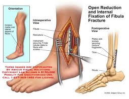 Orif Of Fibula Fracture Ankle Fracture Ankle Surgery Broken Ankle Recovery