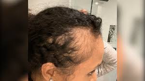Curls are all we do! Devacurl Customers Say Product Causes Hair Loss It S Devastating National Globalnews Ca