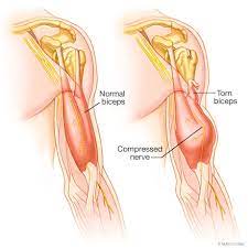 Biceps Tendonitis - Overview - Mayo Clinic Orthopedics & Sports Medicine