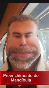 Se você acha que melhorar o contorno de mandíbula é sinônimo de  preenchimento, melhor assistir este vídeo antes de procurar um tratamento.,  Um forte abraço,, Dr Alex Martinelli. , CRM 52735736, Rua ...