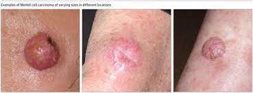 Merkel cell carcinoma is a highly aggressive primary cutaneous neuroendocrine carcinoma primarily affecting elderly and immunosuppressed individuals. Why Merkel Cell Cancer Is Garnering More Attention Jama X Mol