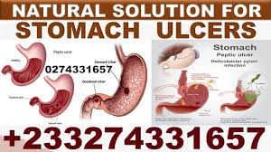 What follows are some suggestions on how to prevent ulcers from developing: Natural Way To Treat Stomach Ulcer Seek Ghana