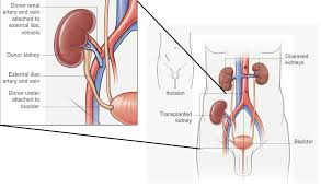 Kidney Transplant Procedure Step By Step Medmonks Kidney Transplant Kidney Transplant