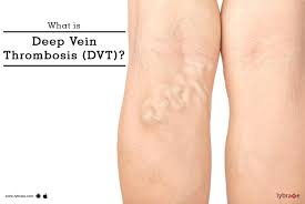 What Is Deep Vein Thrombosis Dvt Symptoms Treatment Prevention By Dr Rajendra Bansal Lybrate