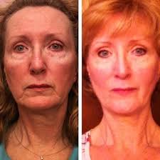 Open your mouth and create a circle in o shape, following the posture smile lifting your cheeks and face in an upward direction. Exercises To Get Rid Of Sagging Jowls Exercise Poster