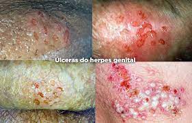 HERPES GENITAL | Cont&aacute;gio, Sintomas e Tratamento