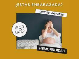Hemorroides Y Varices Vulvares En El Embarazo Cifip Suelo Pelvico Alicante Centro Integral De Fisioterapia Perineal